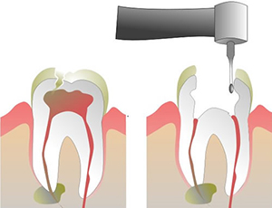 Root Canal Treatment