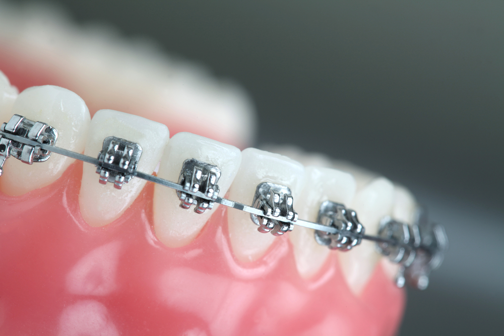 top-self-ligating-braces-orthodontics-in-india