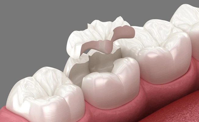Denture fabrication